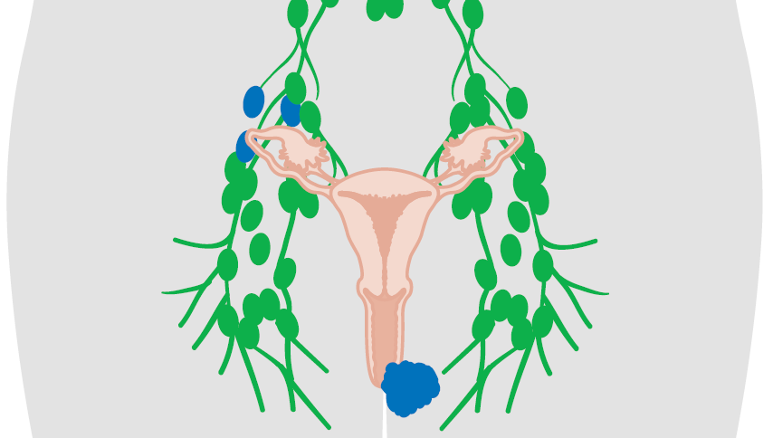 Inguinofemoral Lymph Node Dissection (Full)