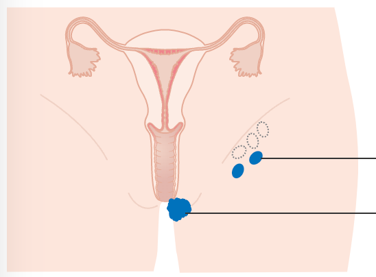 Vulvar Cancer Groin Management