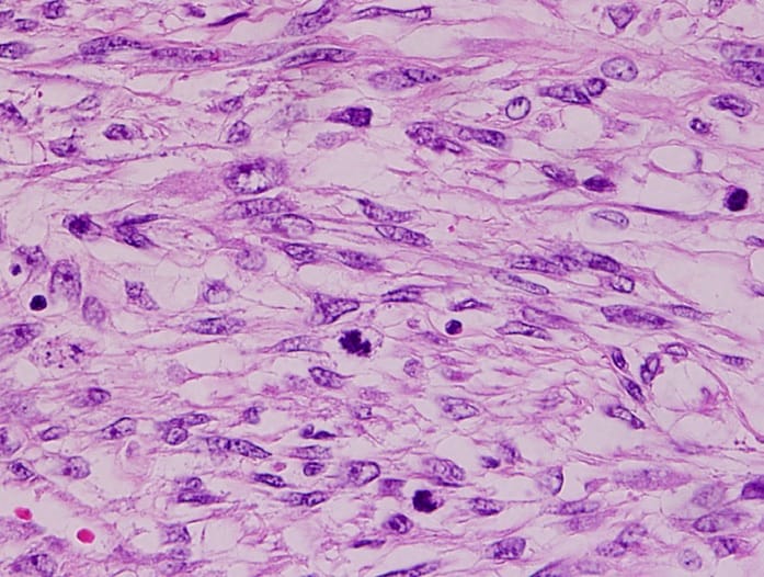 Sarcoma Trials